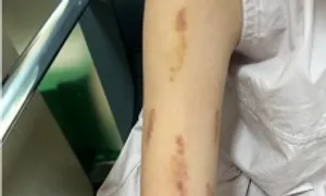 Rối loạn hành vi, bé gái tự cào cấu cơ thể Rối loạn hành vi, bé gái tự cào cấu cơ thể
