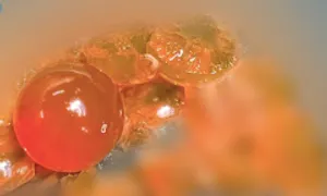 Bé trai 14 tháng tuổi nuốt nhầm hạt nở